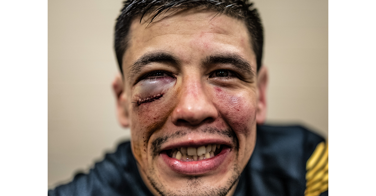 Así quedó el rostro de Brandon Moreno tras coronarse campeón de la UFC