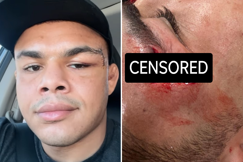 Nikolas Motta shows off nasty facial gash that has forced UFC 287 withdrawal