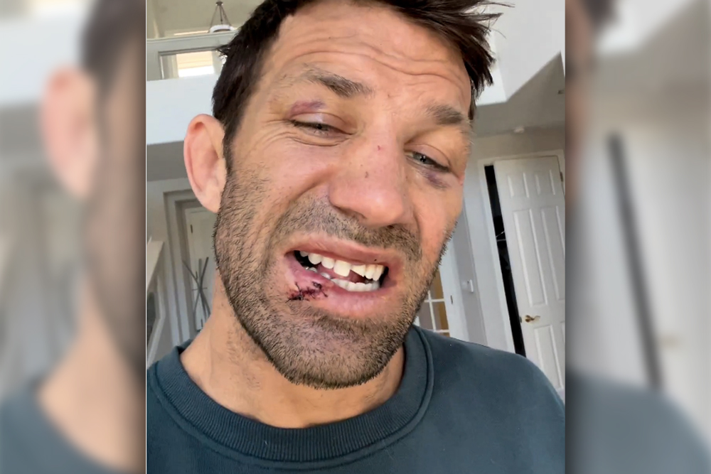 Luke Rockhold shows tooth damage after BKFC 41 loss and vows he’s not done