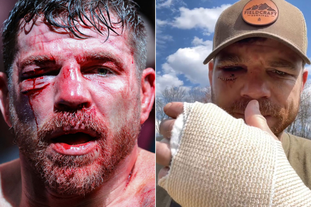 Jim Miller suffered broken hand and toe in UFC 300 loss to Bobby Green: ‘The struggle is real’