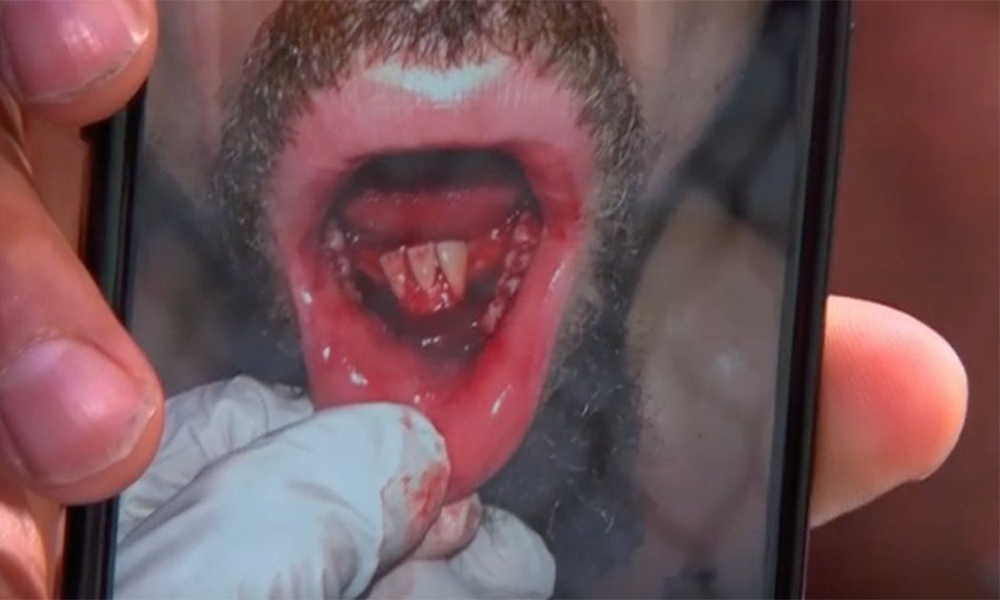 Graphic photo shows Robert Whittaker’s mangled jaw from Khazmat Chimaev at UFC 308